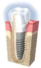 зубные имплантанты, имплантология